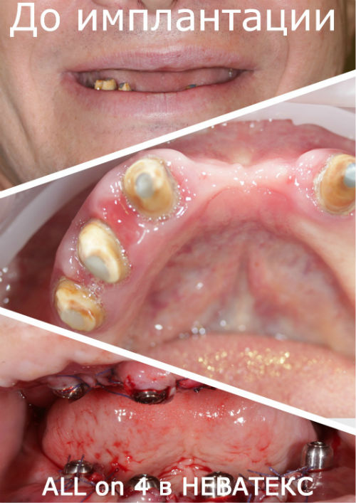 Фото до перации All on 4 Фото до перации All on 4